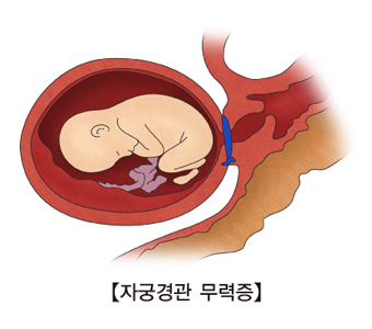 자궁경부 원형결찰술(맥도날드 수술)