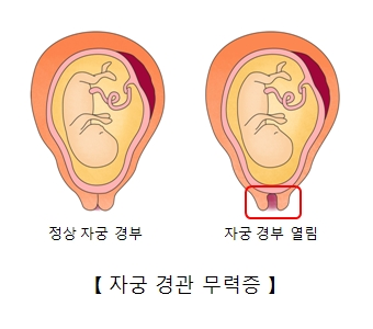 정상 자궁 경부와 자궁 경부 열림 비교